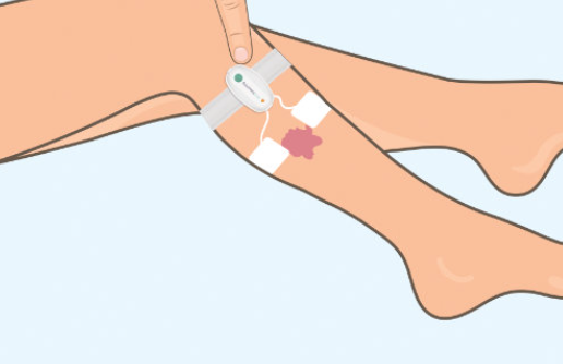 ACCEL-HEAL SOLO: ELECTRICAL STIMULATION WOUND THERAPY FOR PAINFUL AND HARD-TO-HEAL WOUNDS - Healium.me