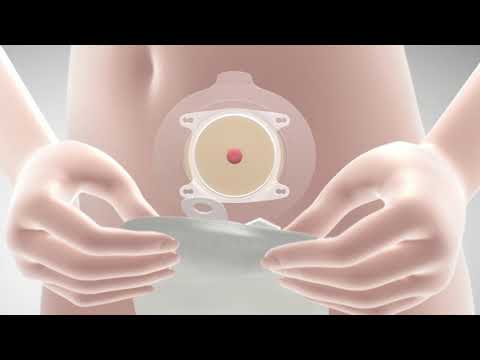 Sensura® Mio Click Open Maxi 70mm - Transparent - 30/Box